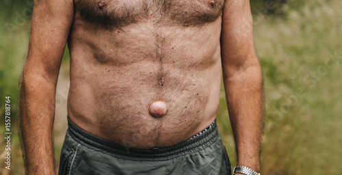 Photograph of an elderly man, grandfather with a large umbilical hernia inherited. Concept of disease.