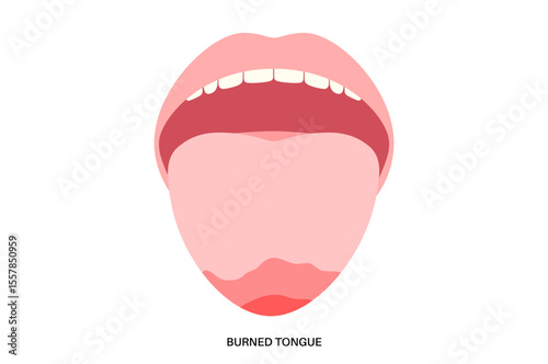 Burned tongue poster