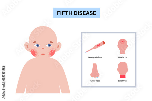 Fifth disease or erythema infectiosum