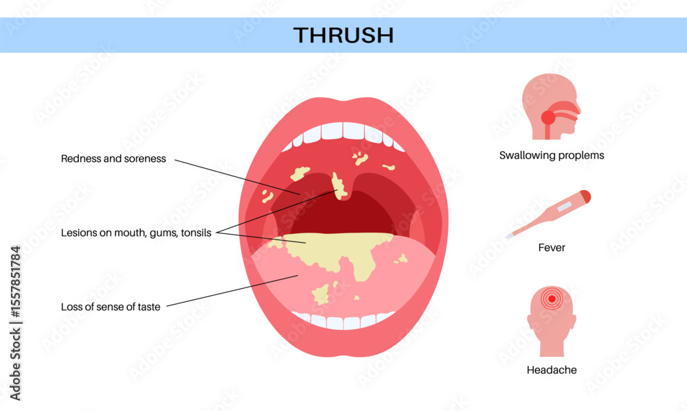 Fototapeta premium Thrush disease poster