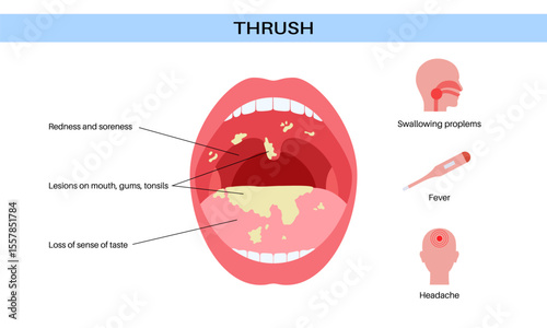 Thrush disease poster