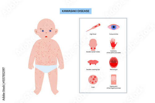 Roseola or exanthem subitum