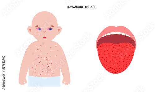 Kawasaki disease poster