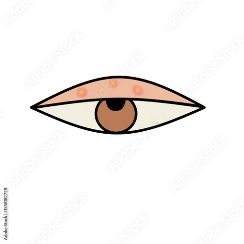eye disease conjuctivitis infection science medical illustration.eps
