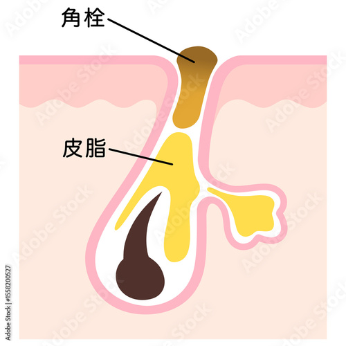 Konstfotografi 毛穴の断面　角栓と皮脂　詰まった毛穴