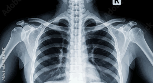 Human Chest X Ray Image Displaying Rib Cage and Spine
