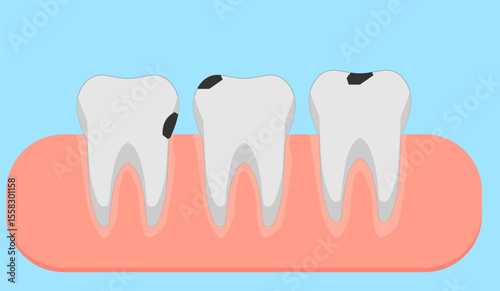 teeth with caries in the gum on a blue background,