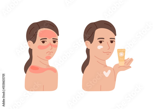 Woman with red skin from sunburn and apply protection cream for skin care. Sun protection concept for summer safety. Flat vector illustration