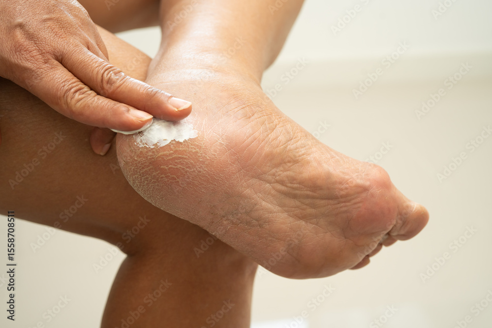 Fototapeta premium Asian woman applying moisturizing cream skincare treatment to solve and repair feet with crack and dry heel skin.