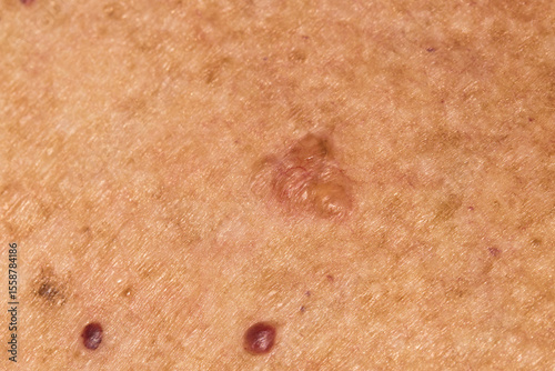 Basal cell carcinoma on the chest of a seventy year old Caucasian woman who has lived all her life in Africa