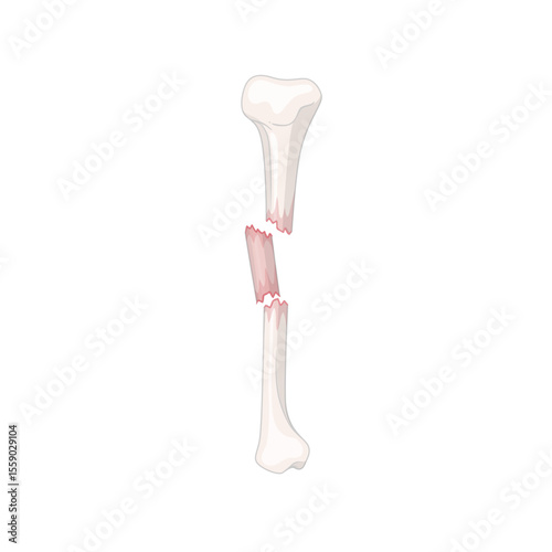 Shattered Bone: A detailed medical illustration presents a stark view of a broken bone. The illustration underscores concepts such as fragility, injury, pain and the imperative of medical care.