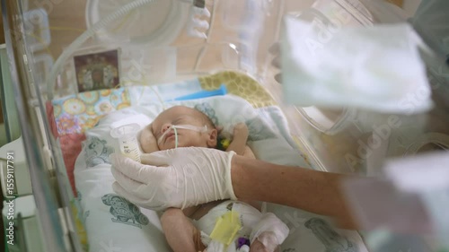 A premature infant is being fed milk in an intensive care unit, highlighting neonatal care and early nutrition. A premature infant receives milk feeding in a neonatal intensive care unit (NICU)