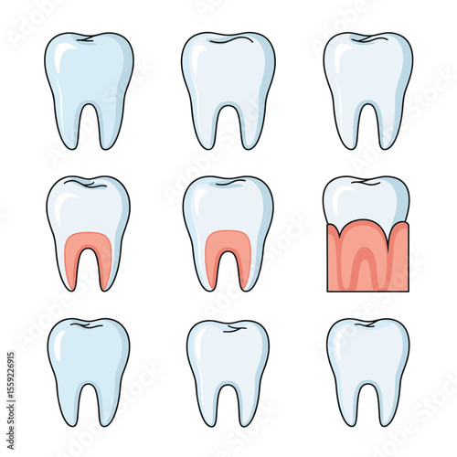 Gum Disease Stages Illustrations of Healthy and Unhealthy Gums and Teeth