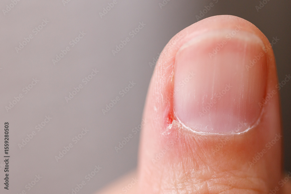 Macro close-up of a human finger with an inflamed hangnail and visible skin irritation. Useful for dermatology, skincare products, or nail care industry. Macro close-up of a human finger with an inflamed hangnail and visible skin irritation. Useful for dermatology, skincare products, or nail care industry.
