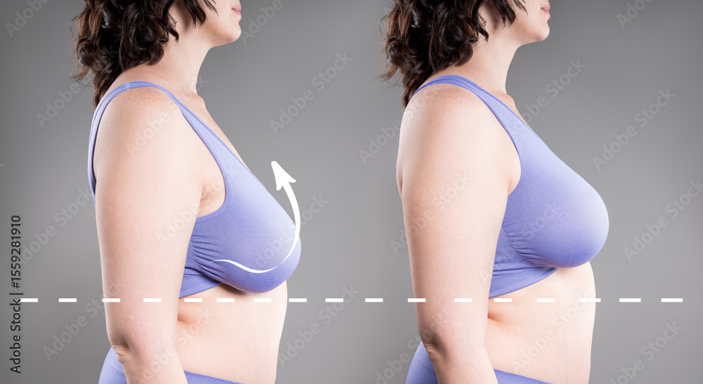 Fototapeta premium Before and after breast augmentation, woman with large saggy breasts, reduction mammoplasty, plastic surgery, aesthetic, healthcare and medicine concept