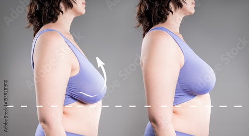 Before and after breast augmentation, woman with large saggy breasts, reduction mammoplasty, plastic surgery, aesthetic, healthcare and medicine concept