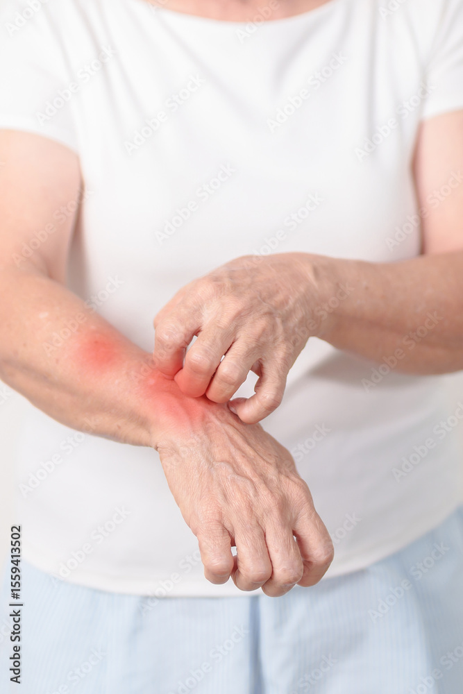 Elderly woman itching arm and body scratching for Skin Allergy from insect bite and food dermatitis. Dermatology, Leprosy day, Systemic lupus erythematosus, Psoriasis, Urticaria and rash Eczema Elderly woman itching arm and body scratching for Skin Allergy from insect bite and food dermatitis. Dermatology, Leprosy day, Systemic lupus erythematosus, Psoriasis, Urticaria and rash Eczema