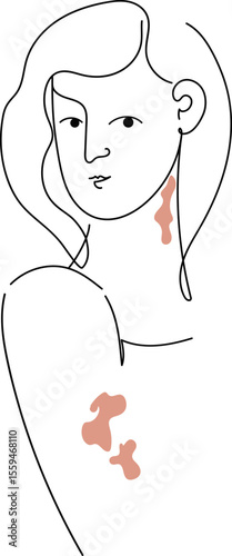 Psoriasis awareness month concept with woman having skin patches. Health month. Global skin disorder awareness. International disease concept.Linear  png vector illustration.