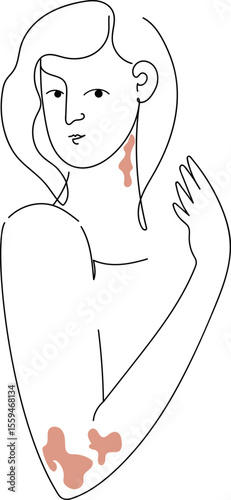 Psoriasis awareness month concept with woman having skin patches. Health month. Global skin disorder awareness. International disease concept.Linear  png vector illustration.