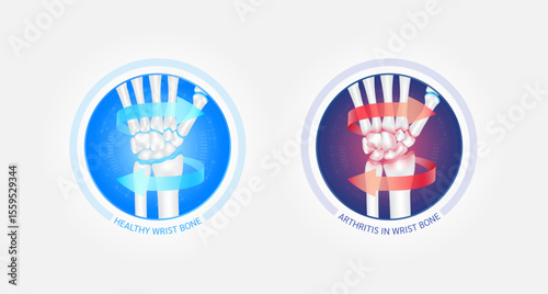 Healthy wrist bone and arthritis or osteoporosis with red blue arrows spin around. Joint hand cartilage becomes worn. Comparative images of normal and inflammation bones. Vector EPS10.