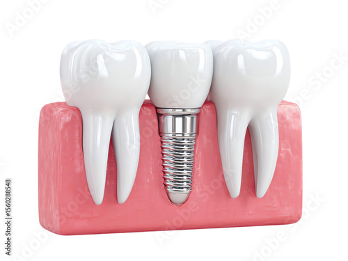 Tooth implant model with three crowns 3d illustration isolated on transparent background png