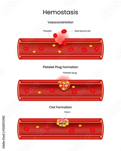 Stages of Hemostasis Vasoconstriction, Platelet Plug, and Clot Formation