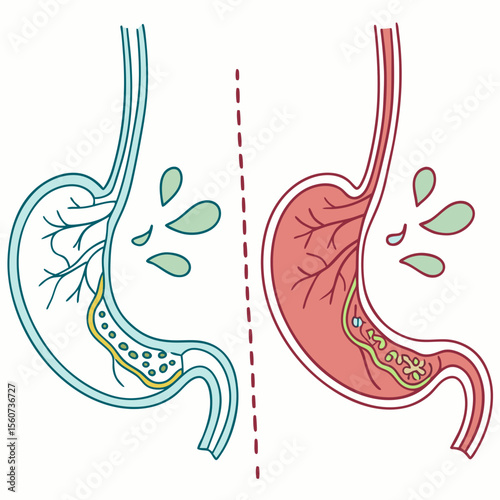 Human stomach. Healthy and unhealthy, Bloating stomach ache, digestive tract pain fullness heaviness stomaches acid heartburn process