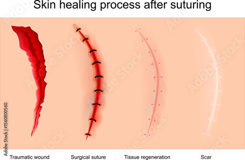 Skin Wound healing following suture closure.