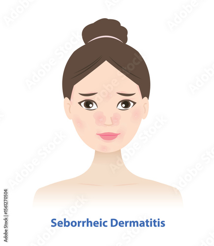 Seborrheic Dermatitis on woman face vector illustration. Sebderm, inflamed, red patches with white or yellow scale the face, sides of the nose, eyebrows, ears, eyelids. Skin care and beauty concept.