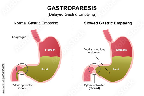 Gastroparesis - Delayed Gastric Emptying Illustration
