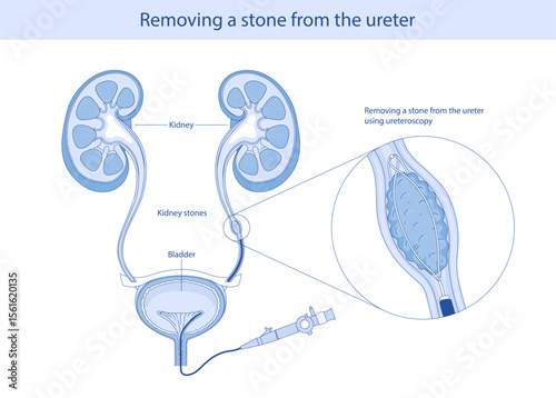 Anatomy, kidneys, ureter, stone, stones, bladder