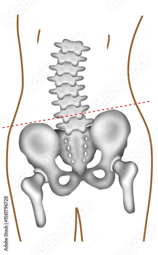 A hand-painted watercolor of lumbar scoliosis causing uneven hip height