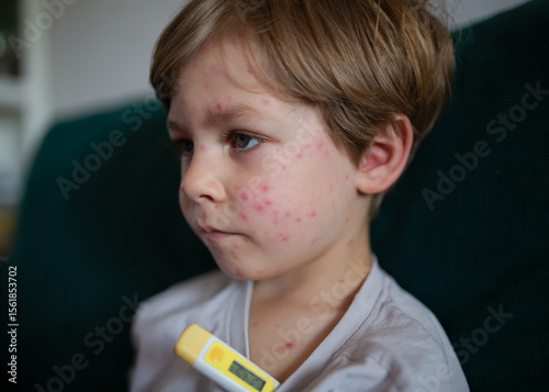Sick child with chickenpox rash and digital thermometer. Close-up portrait of a young boy with varicella infection, sitting on a couch.