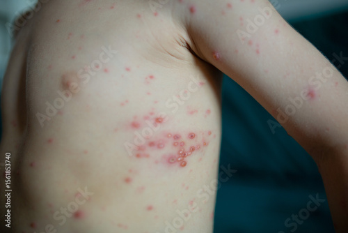 Child torso covered with chickenpox rash. Skin with red itchy blisters caused by varicella virus. Pediatric infectious disease symptoms. 