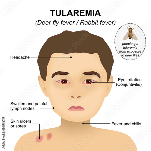 Tularemia - Deer fly fever / Rabbit fever sign and symptoms