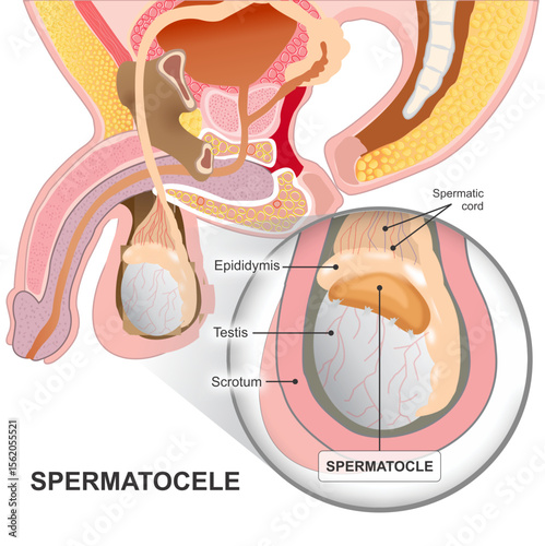 Spermatocele in testis illustration male