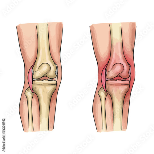 Knee joint anatomy and injury illustration showcasing medical science and orthopedic health for education