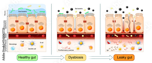 Leaky gut. gut microbiota