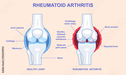 Rheumatoid Arthritis medical infographics. Educational diagram with healthy and diseased knee joint. Auto immune disease. Anatomical structure of affected knee. Flat vector illustration