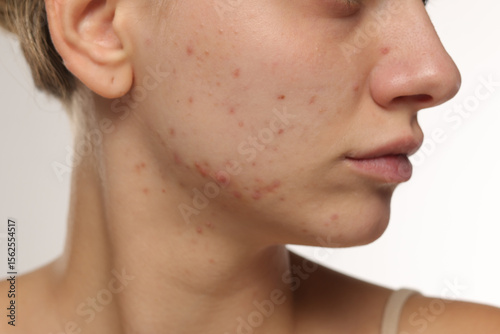 Studio closeup of young woman with acne on cheek and jawline, skincare concept, white background