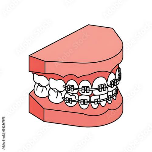 Dental braces model showing orthodontic structure.