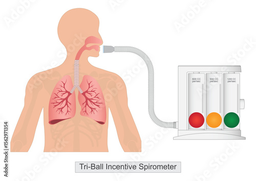 Tri ball incentive spirometer with human Lungs.