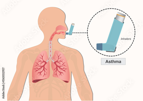 Asthma is a chronic lung disease affecting.
