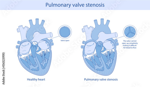 pulmonary valve stenosis. anatomical illustration