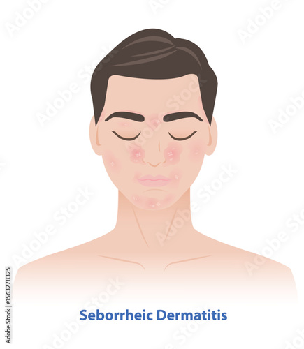 Seborrheic Dermatitis on man face vector illustration. Sebderm, inflamed skin, scaly patches, flakes over the oilier areas of the face, over the eyebrows, sides of the nose, beard area, ears, eyelids.