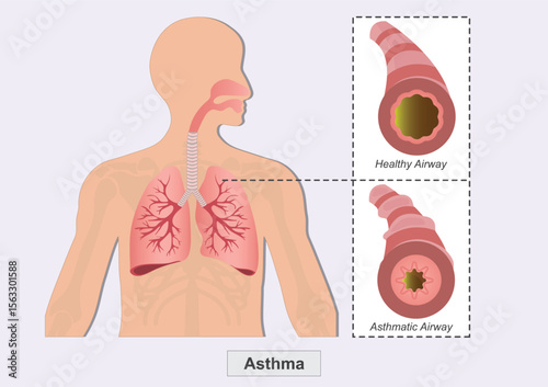 Asthma is a condition in which airways narrow.
