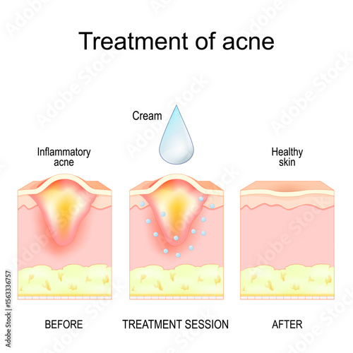 Inflammatory acne pimple before and after treatment rocedure