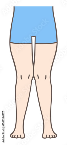 X脚（外反膝）、女性の下肢