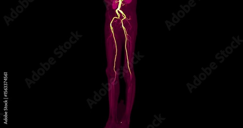 CTA femoral artery run off with color showing femoral artery for diagnostic  Acute or Chronic Peripheral Arterial Disease.