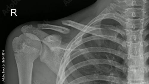 Displaced right clavicle fracture X-ray, with misalignment of bone ends.